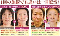 小顔　コルギ