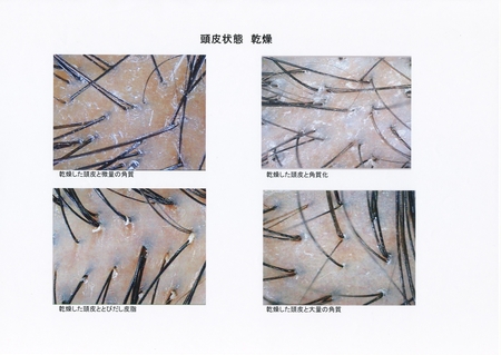 頭皮乾燥