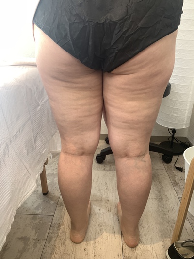 セルライトがあると見た目が美しくないのも悩み。。 セルライトがあると見た目が美しくないのも悩み。。